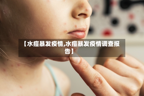 【水痘暴发疫情,水痘暴发疫情调查报告】